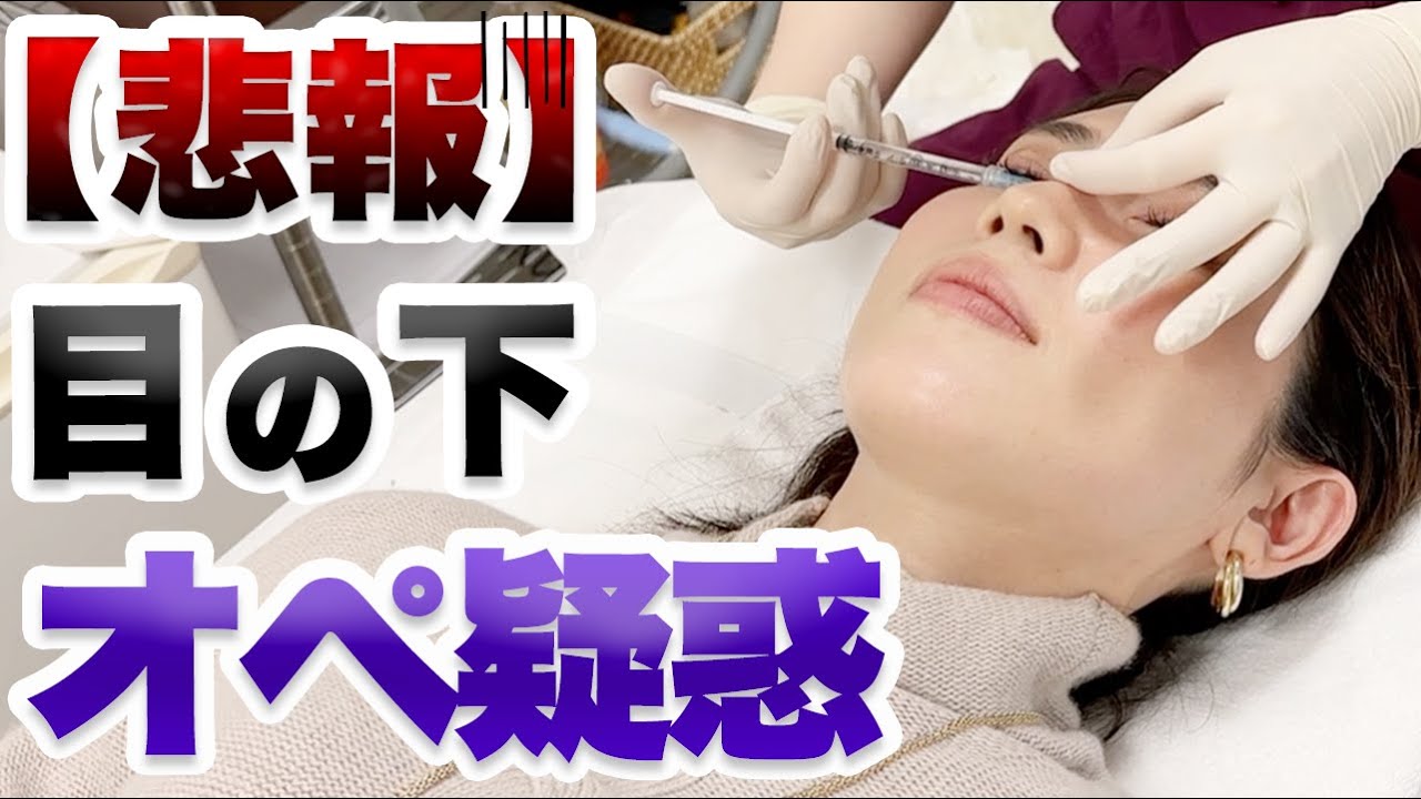 スネコス注射を受けてきたので施術やダウンタイムの様子をお見せします。