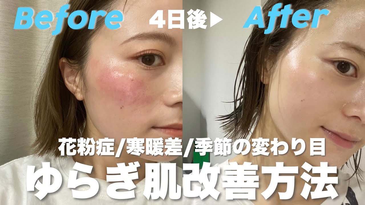 【肌荒れ】たった4日で改善!? "15年花粉症の私の春の肌あれケア方法!!"【ゆらぎ肌】