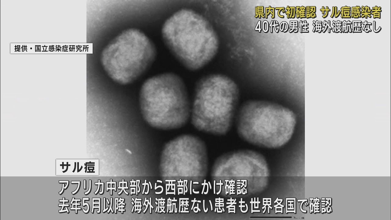 静岡県初…40代男性が「サル痘」に感染　海外渡航歴なく状態は安定