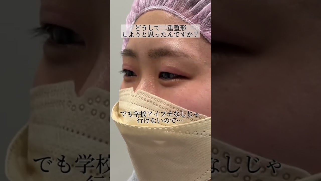【二重整形】アイプチ地獄からの卒業！涙の二重整形！！　#shorts