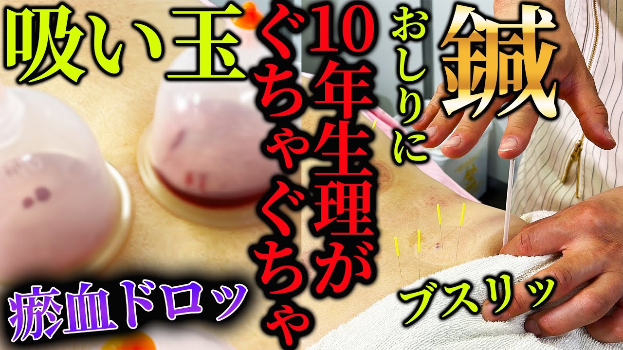 【生理　吸い玉瘀血】瘀血ヒドい　10年間生理前ぐちゃぐちゃPMSは吸い玉と鍼で改善　自宅でできる方法も伝授 【鍼灸院　横浜元町　銀座日本橋】