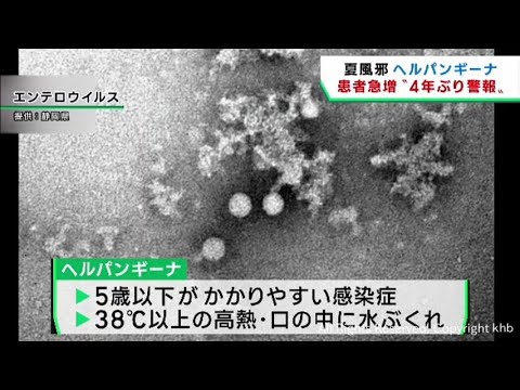 夏風邪の一種ヘルパンギーナ患者が急増　宮城県が警報を出し感染予防徹底を呼び掛け