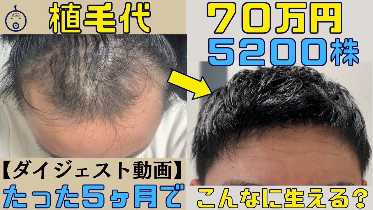 【感動】M字ハゲの悩み トルコ植毛〜5ヶ月経過を一気に見せます!!【自毛植毛｜70万円｜5200株】