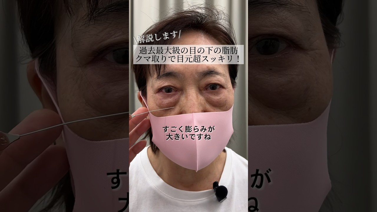 【クマ取り】過去最大級の目の下の脂肪 クマ取りで目元超スッキリ！ #shorts