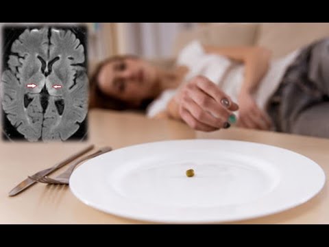 【ウェルニッケ脳症】動けない原因はビタミンB1欠乏が原因だった！