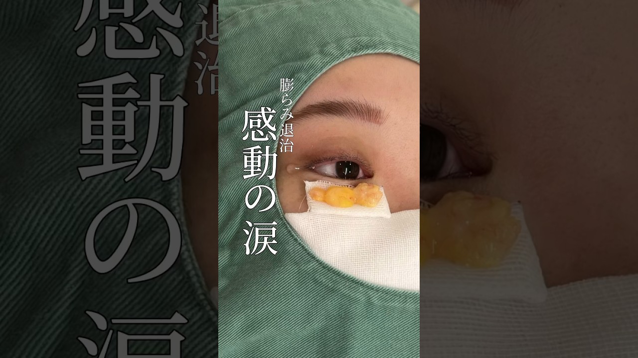 【目の下のクマ取り】閲覧注意　膨らみ退治　感動の涙#shorts