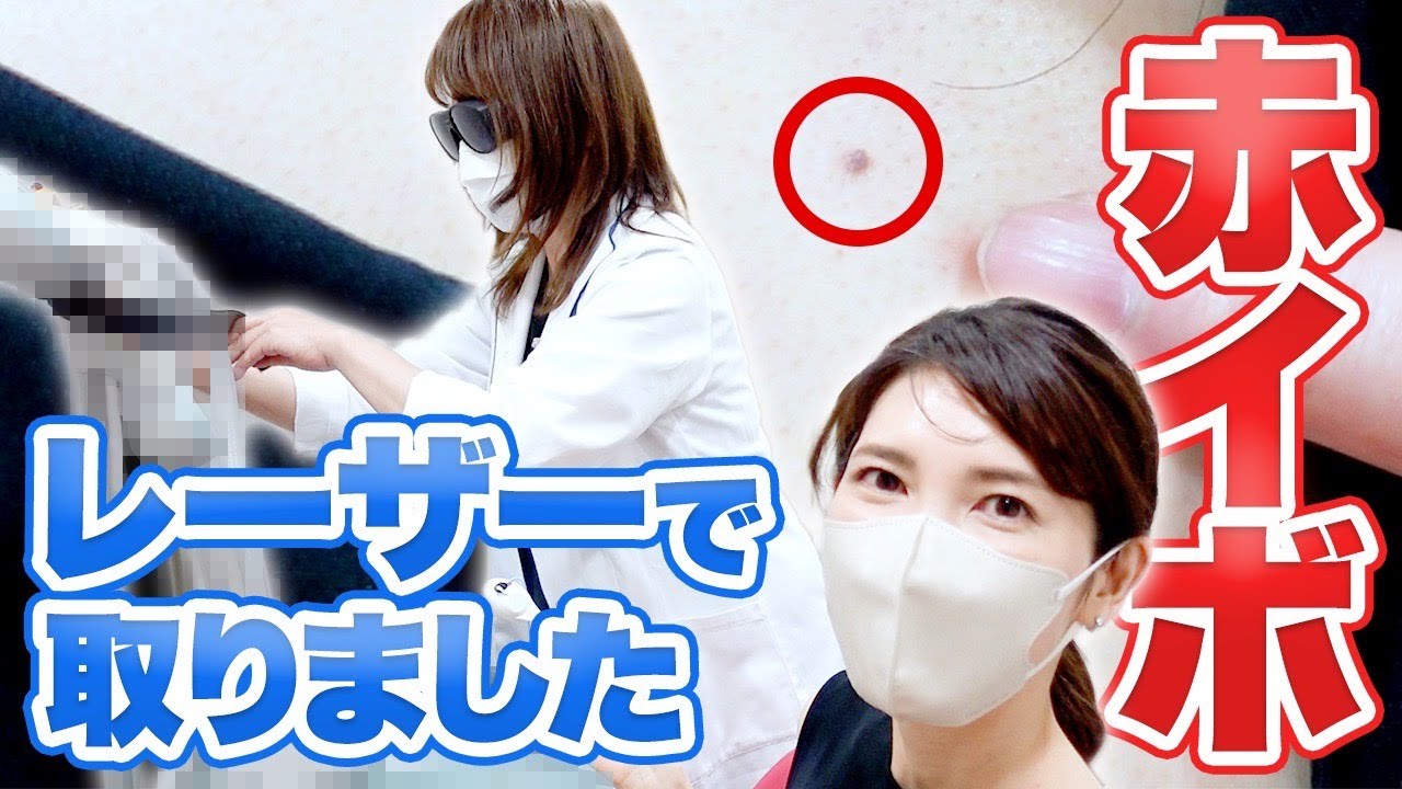 背中の赤イボ(血管腫)をレーザーで治療したら秒で終わりました！