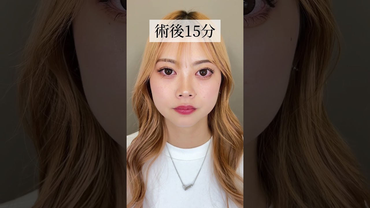【二重整形】はんなりーず　モモ二重整形に密着　#shorts