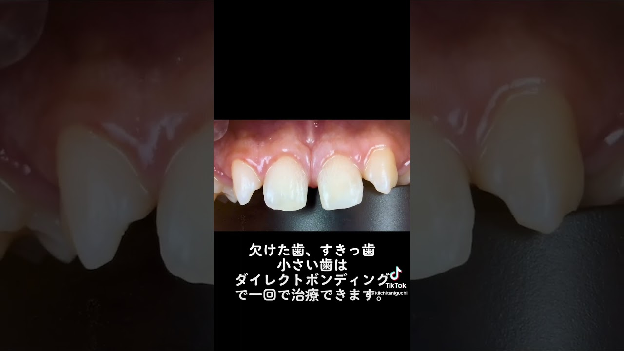 欠けた歯、すきっ歯、小さい歯はダイレクトボンディングで1回の治療で治ります！！