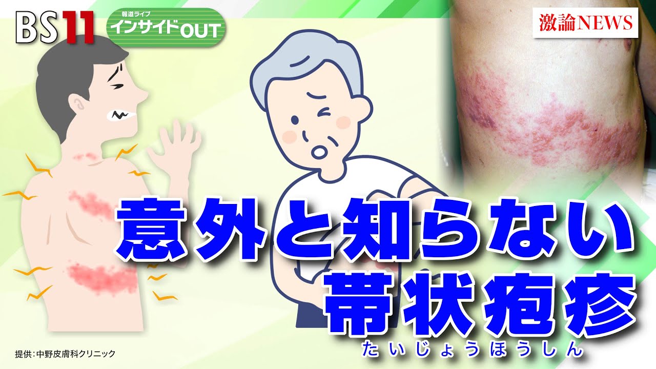 【意外と知らない　帯状疱疹】50歳を過ぎたら要注意！知識と予防法　ゲスト：松尾光馬（中野皮膚科クリニック 院長）、松井宏夫（医学ジャーナリスト）　8月31日（木）報道ライブインサイドOUT