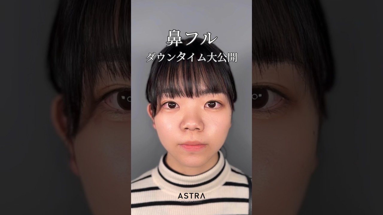 【鼻フルダウンタイム大公開！】鼻整形をお考えの方はご参考にしてください🤍 #美容整形 #astrabeautyclinic #鼻整形 #小鼻縮小