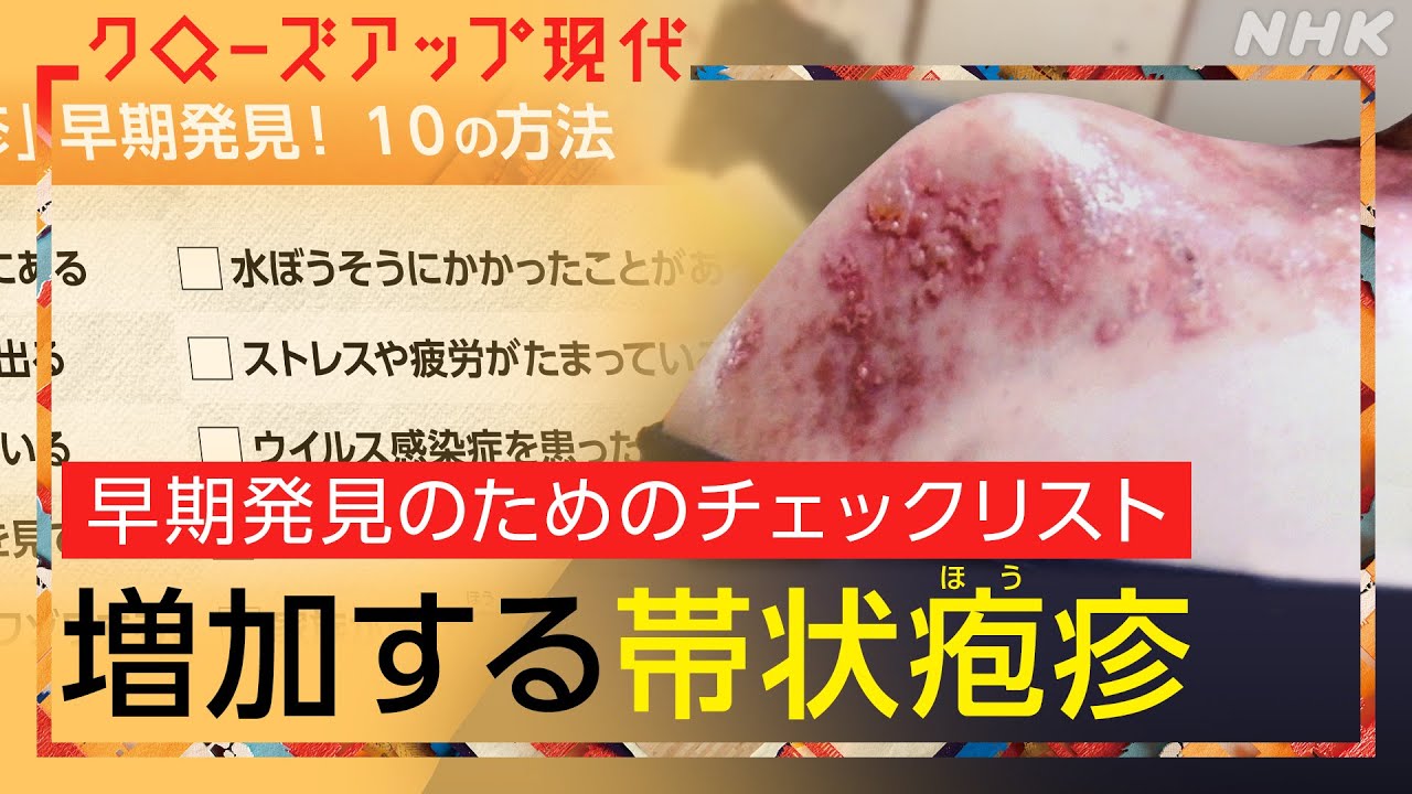 【約3人に1人が発症】激痛ともなう『帯状ほう疹』はなぜ増加しているのか？初期症状は？最新の治療法は？重症化するとどうなる？(語り:小松未可子)【クロ現】| NHK
