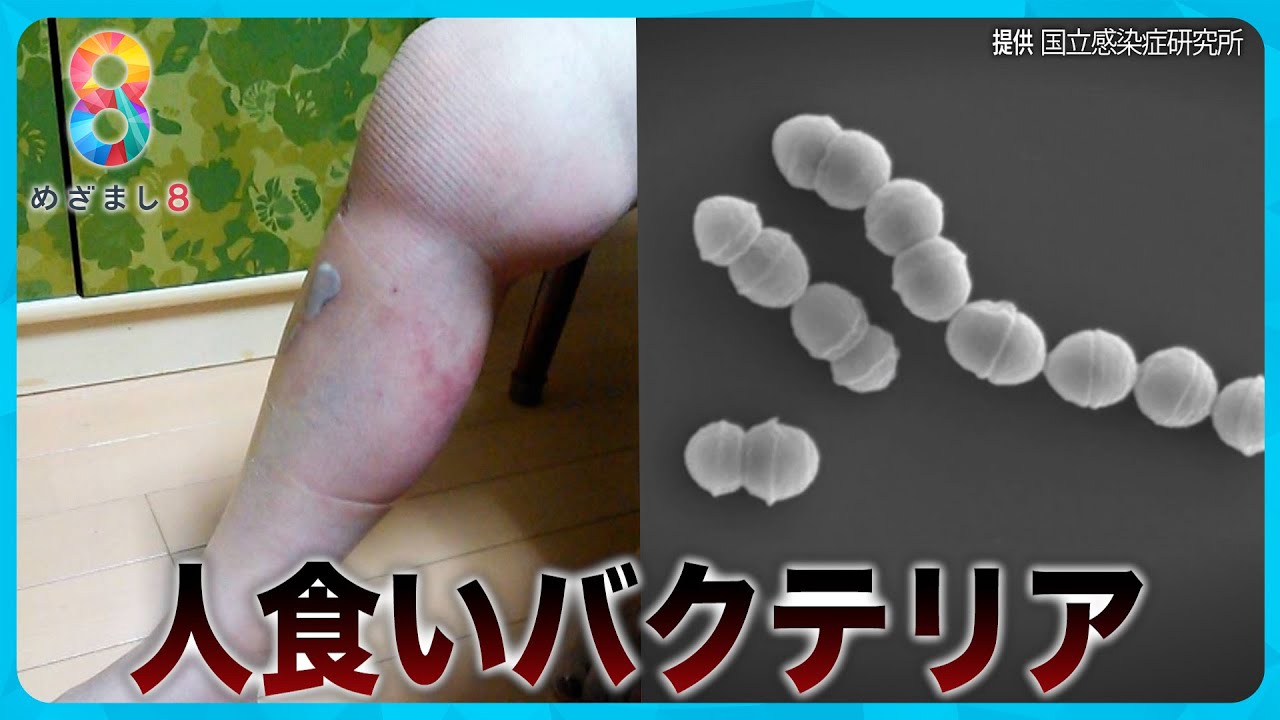 【致死率30%】人食いバクテリア過去最多に ８年前に感染し右脚を失った女性が語る恐怖【めざまし８ニュース】