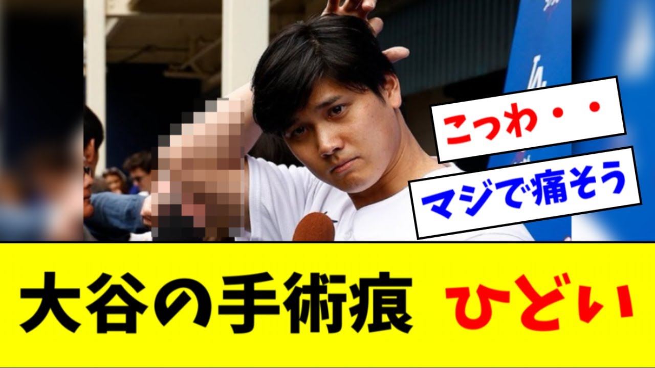 【閲覧注意】大谷翔平 ２回目のトミージョン手術痕、ひどい【2ch なんJ反応】
