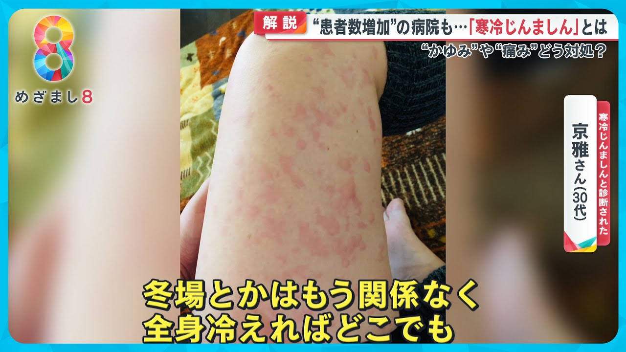 「寒冷じんましん」って？ 女性に多く突然発症し放置すると慢性化のリスクも…【めざまし８ニュース】