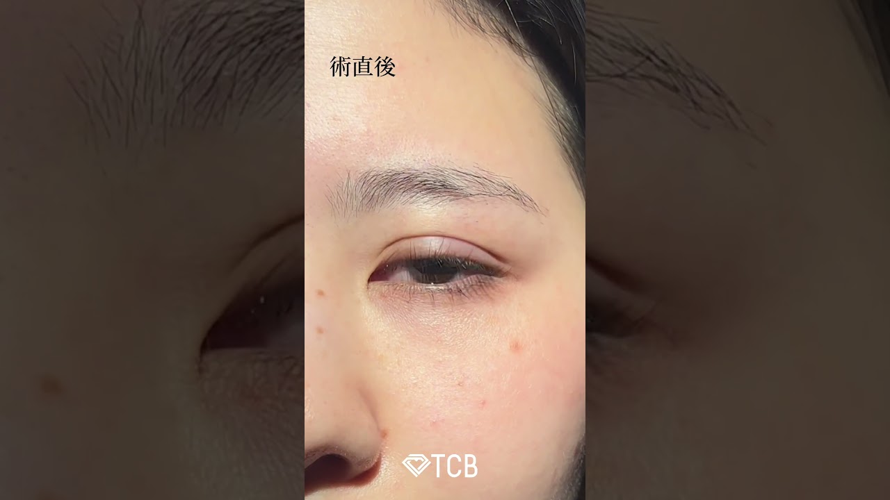 【二重整形】瞳が綺麗すぎる美女の整形