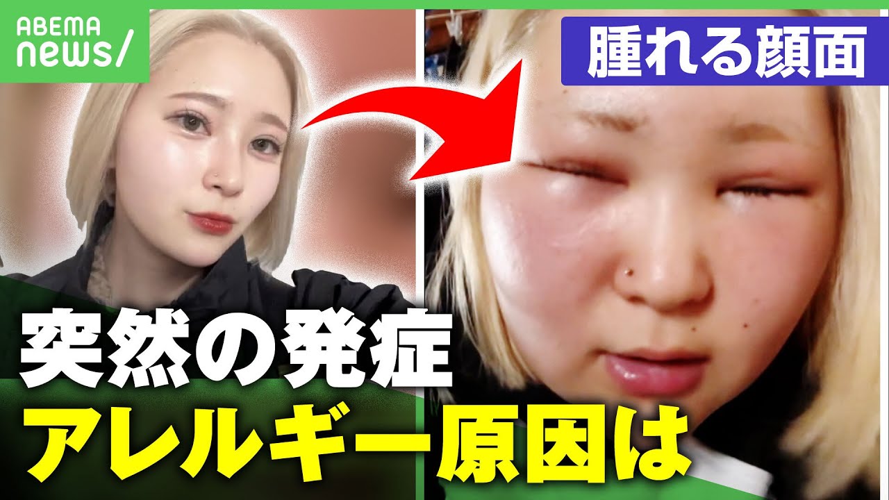 【ブリーチアレルギー】人気TikTokerを襲った"顔の腫れとかゆみ" ヘアカラーで突然発症…進行すると呼吸器症状や嘔吐も｜アベヒル