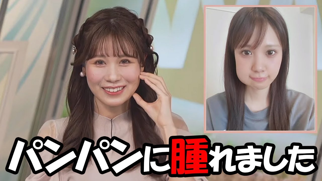 【戸北美月】兼ねてからの願いが叶い親不知を抜いたら見事に腫れたお天気お姉さん