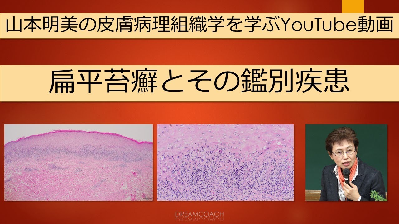 扁平苔癬と鑑別疾患の解説　#dermatopathology  #山本明美  #扁平苔癬　#Lichenplanus