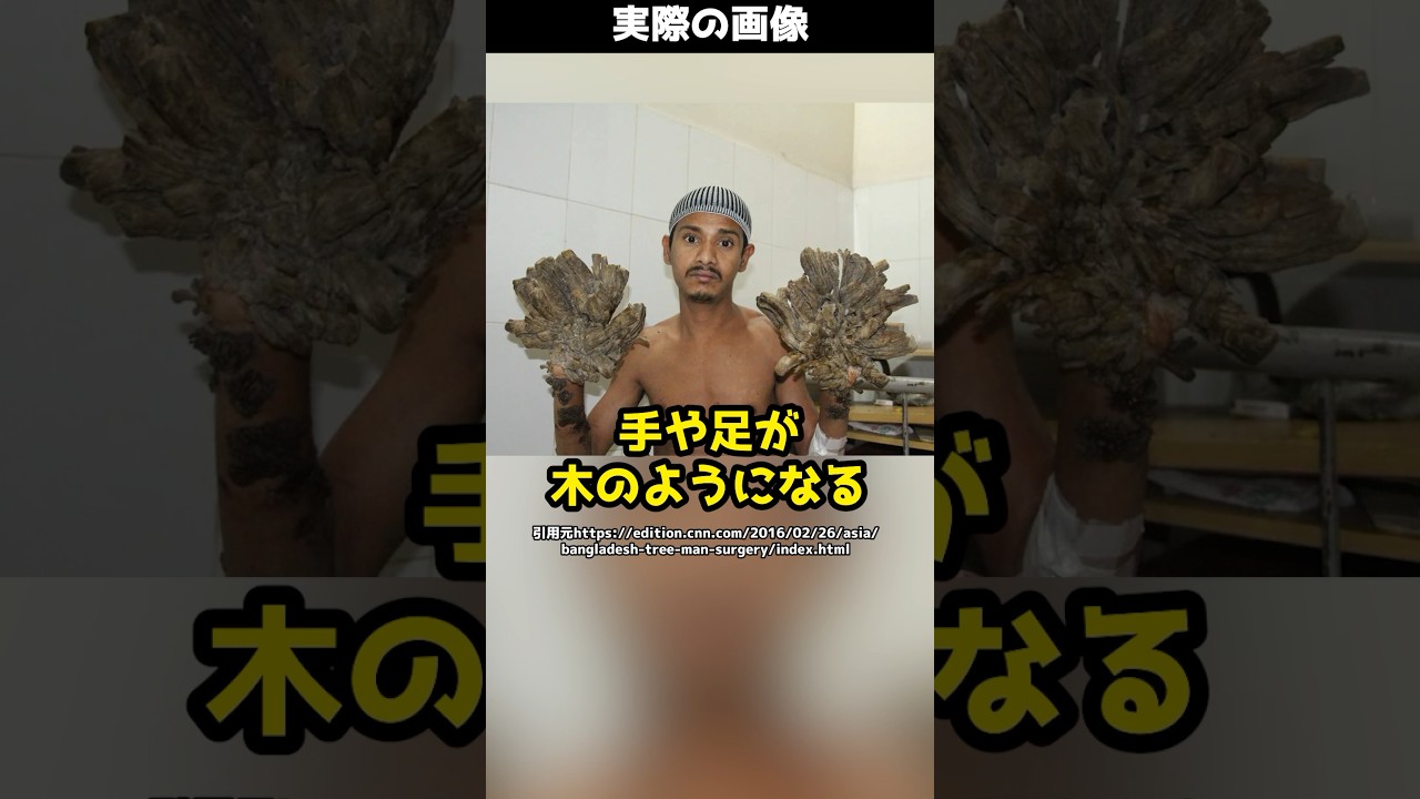 閲覧注意【ツリーマン】手足が木のようになる！？世界でも非常に稀な病気とは！#shorts