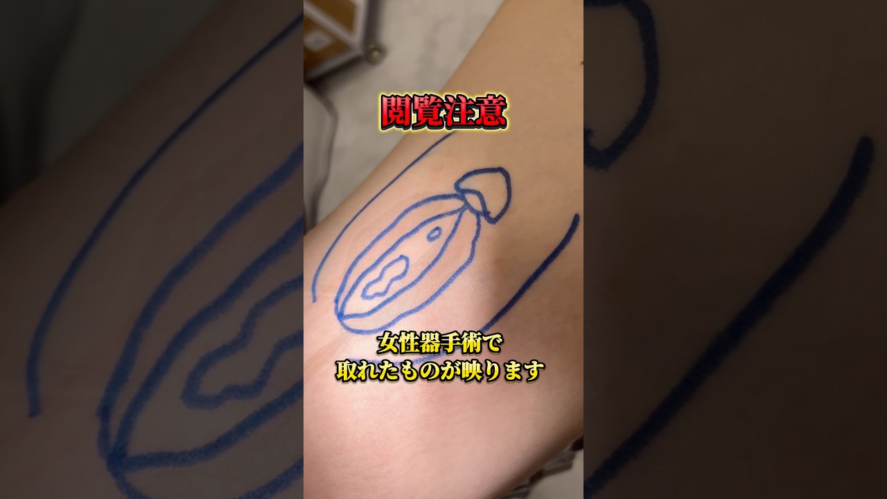 【婦人科形成】女性器手術でとれたものは？#shorts