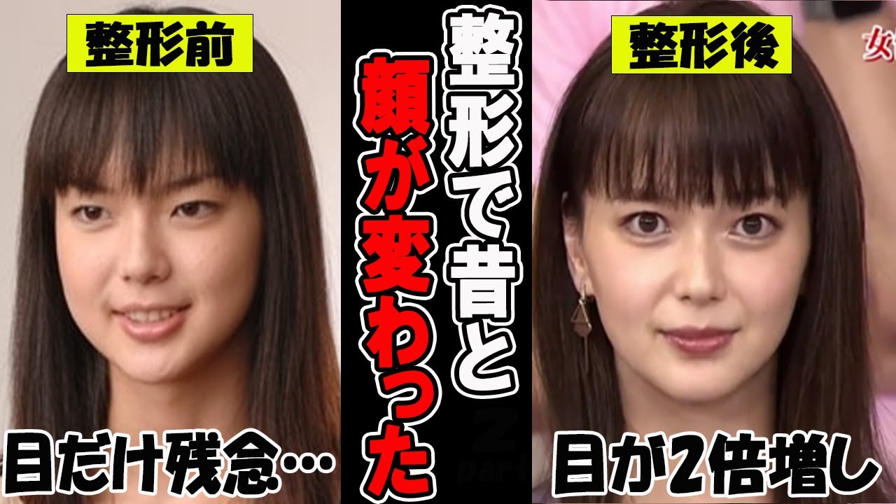 【がるちゃん芸能人】整形で昔と顔が変わった芸能人　衝撃のビフォーアフター！