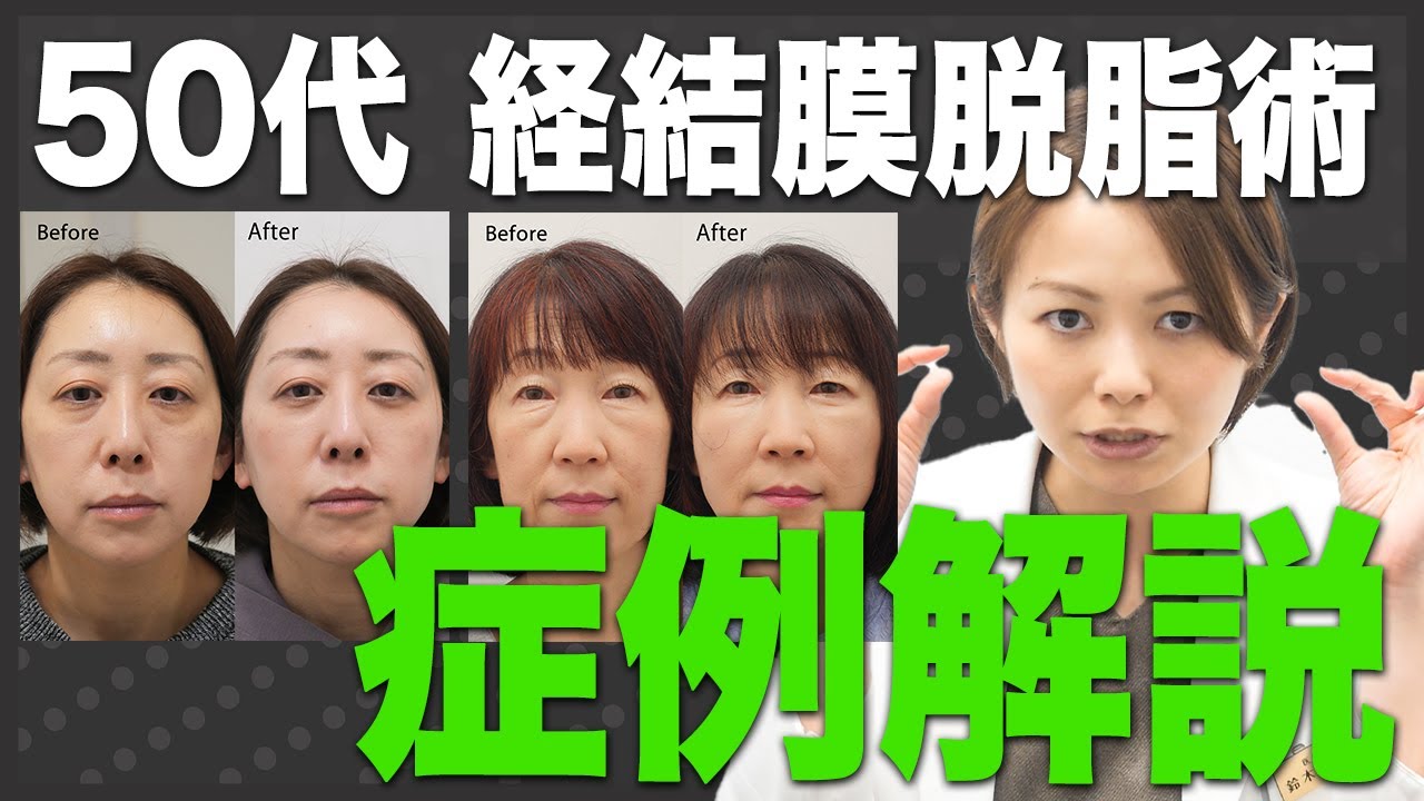 【脱脂は良くないは嘘？】50代は脱脂だけだとダメ？実際に50代で脱脂のみ行った患者様の症例を公開！結論は…？