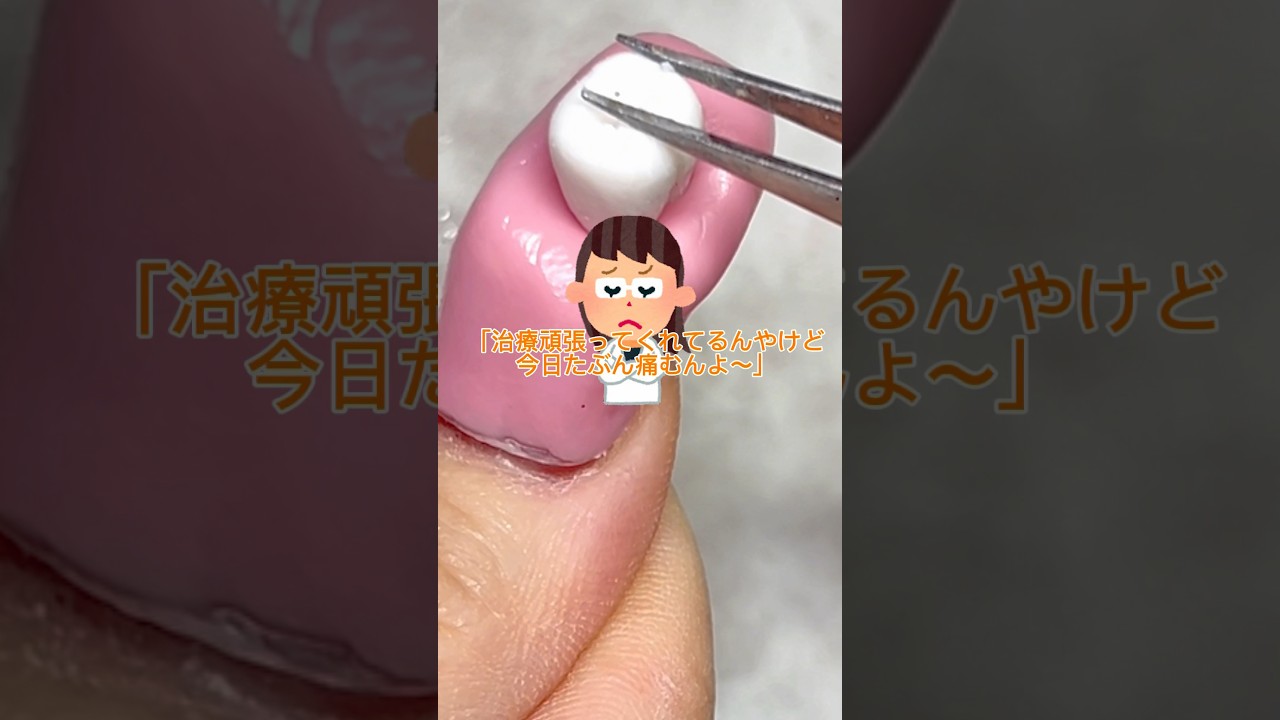 むし歯治療をネイルでしてみた🦷🦷#ネイル #ネイルデザイン #おかば #ジェル #tiktok #歯医者 #虫歯 #日常 #ジェルネイル #shortvideo