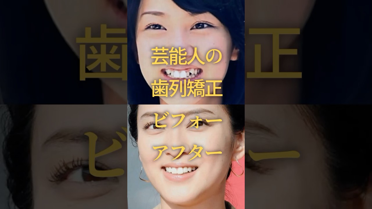 芸能人の歯列矯正ビフォーアフター　#ガルちゃん #芸能人 #歯列矯正