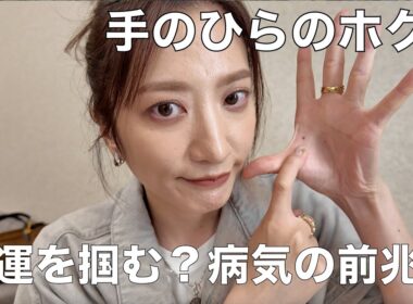 【楽屋雑談】前から気になってた手のホクロ、病院で診てもらった