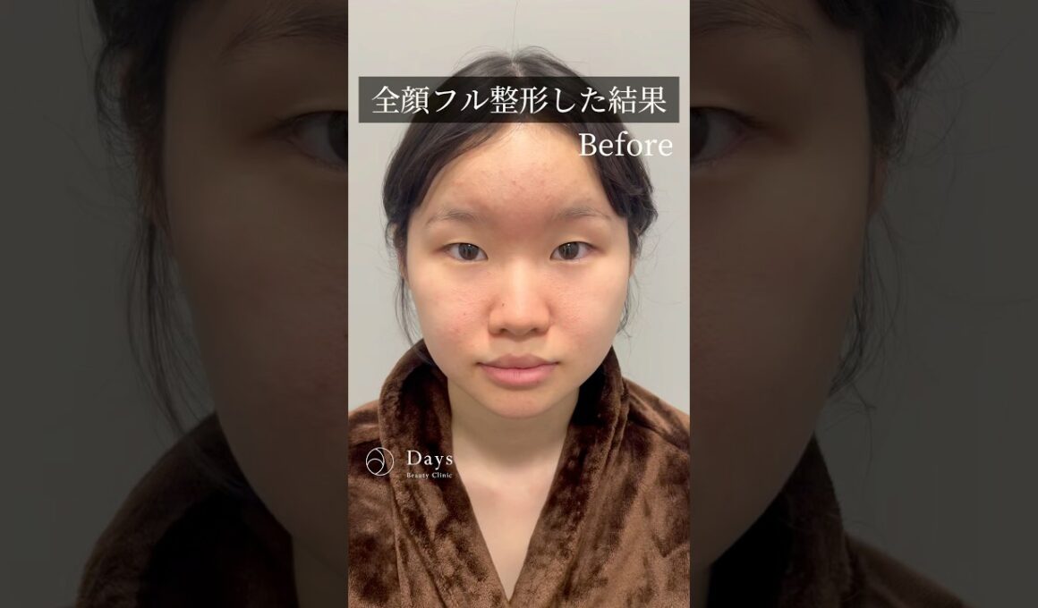 【全顔整形】ナチュラルに垢抜けた！#shorts