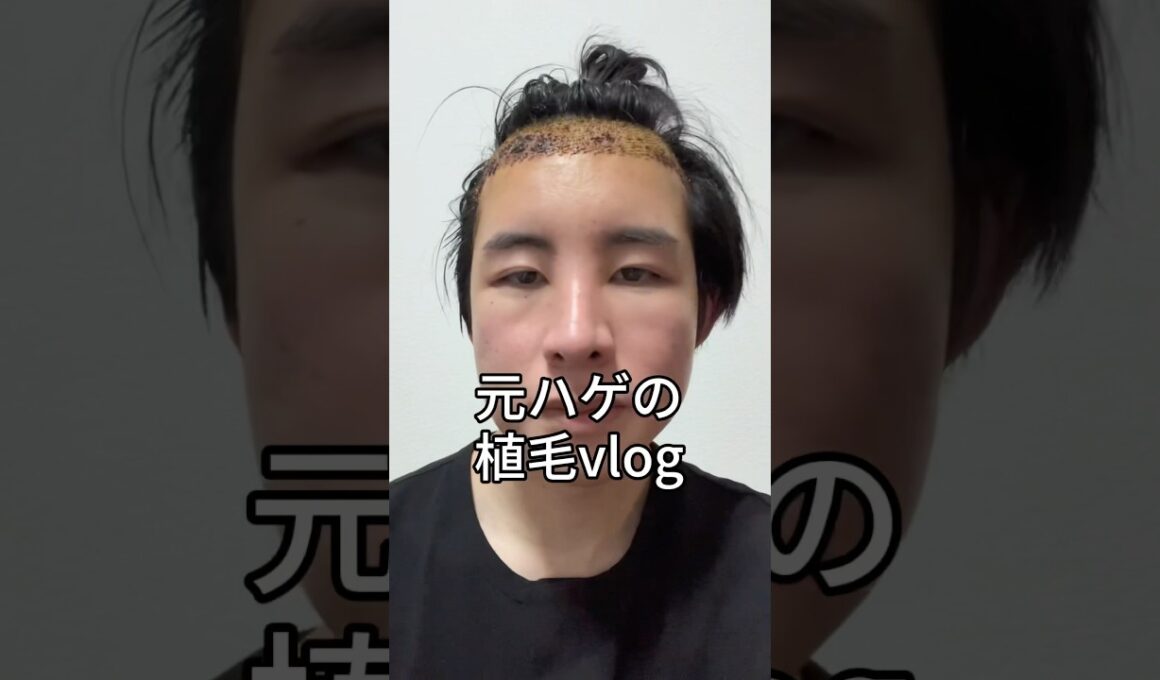 元ハゲの植毛vlog 質問があれば回答するのでお気軽にコメントください☺︎ #整形 #美容整形 #垢抜け #垢抜け方法 #ビフォーアフター #ハゲ #植毛 #育毛 #トルコ