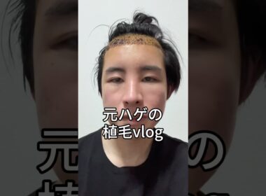 元ハゲの植毛vlog 質問があれば回答するのでお気軽にコメントください☺︎ #整形 #美容整形 #垢抜け #垢抜け方法 #ビフォーアフター #ハゲ #植毛 #育毛 #トルコ