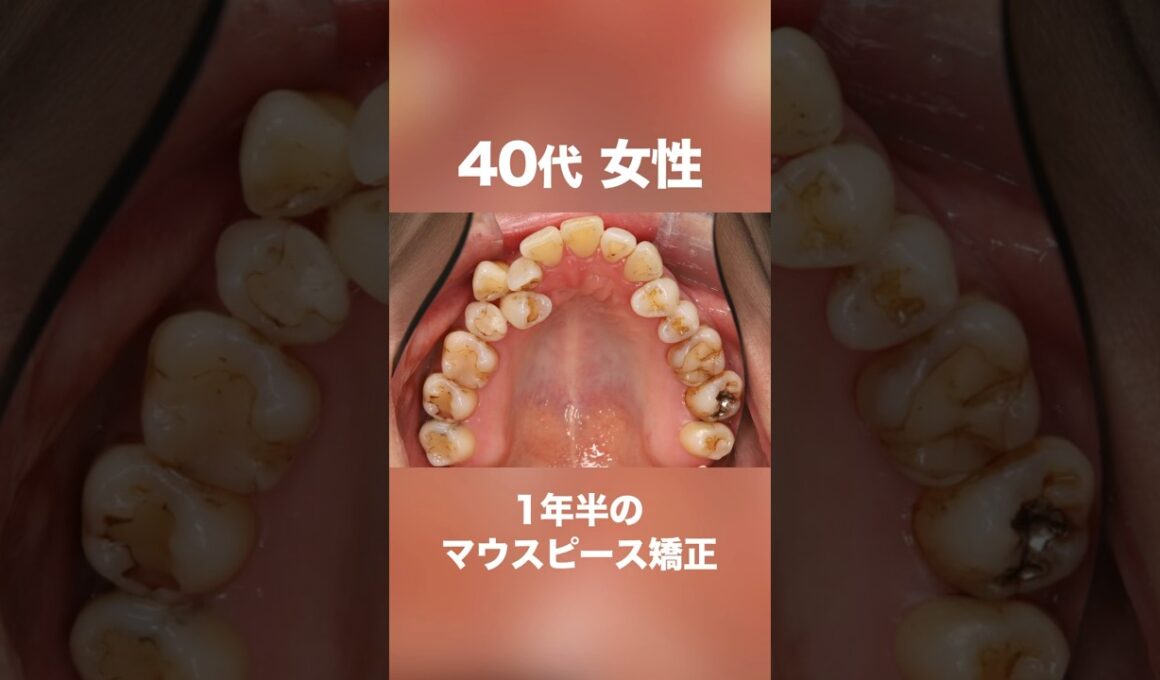 ワイヤーではなくマウスピース矯正で治したい方必見#shorts #矯正#歯列矯正#マウスピース #マウスピース矯正#歯並び #インビザライン