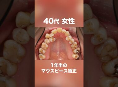 ワイヤーではなくマウスピース矯正で治したい方必見#shorts #矯正#歯列矯正#マウスピース #マウスピース矯正#歯並び #インビザライン