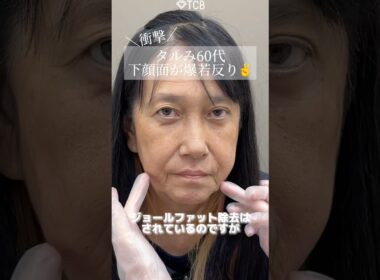 【糸リフト】たるみ60代奇跡級の若返り？#shorts