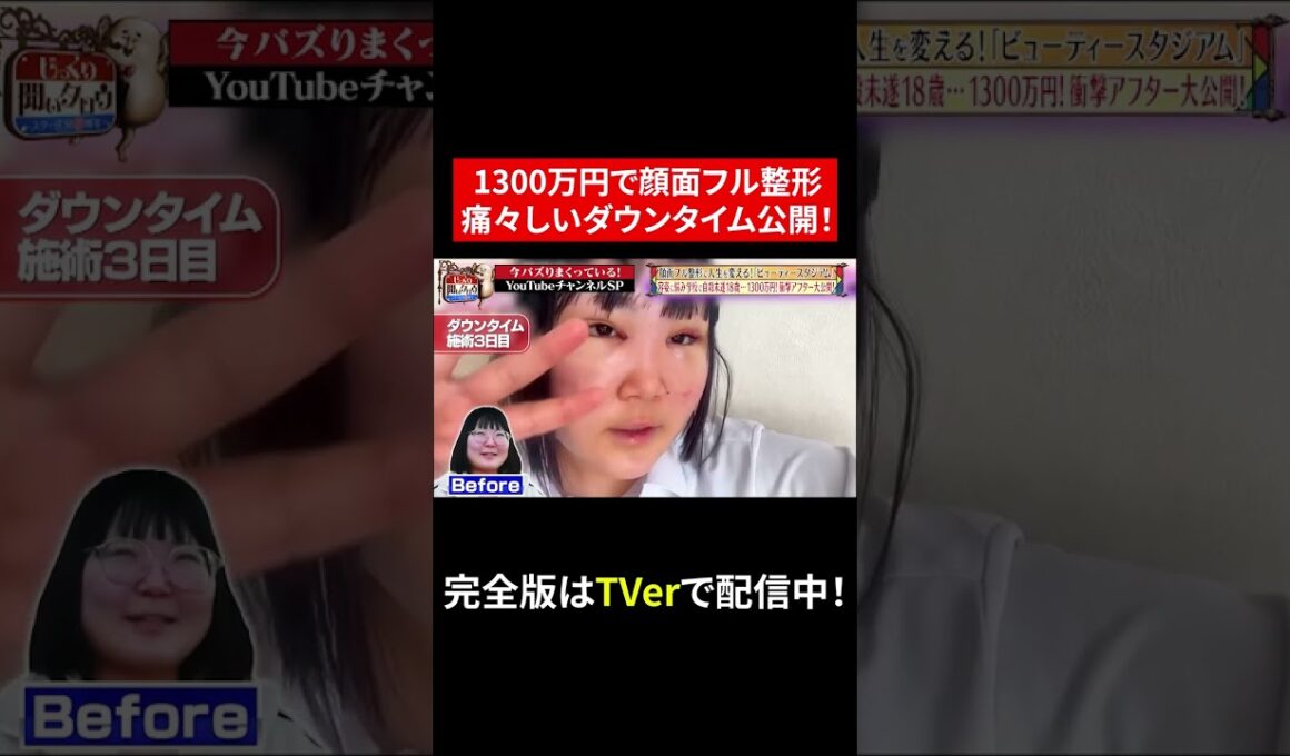 【じっくり聞いタロウ】1300万円でフル整形！痛々しいダウンタイム…