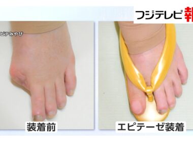 外見に「自信」取り戻し、憧れの結婚指輪写真も…「エピテーゼ」制作現場を山﨑夕貴キャスターが取材（2026年03月31日）