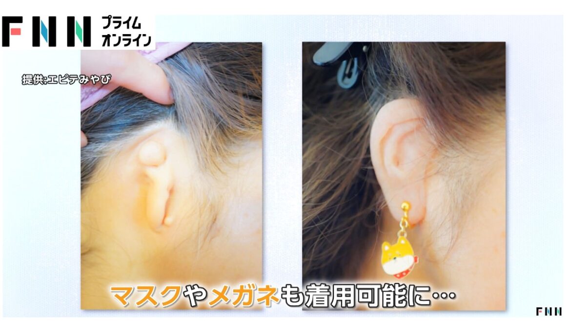 外見に「自信」取り戻し、憧れの結婚指輪写真も…「エピテーゼ」制作現場を山﨑夕貴キャスターが取材（2026年04月03日）