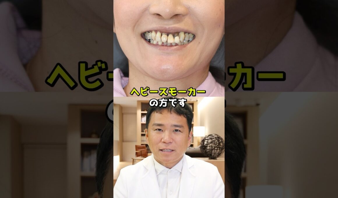 重度の歯周病に悩むヘビースモーカーの女性の歯を全て抜いて機能回復した症例