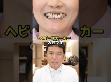 重度の歯周病に悩むヘビースモーカーの女性の歯を全て抜いて機能回復した症例