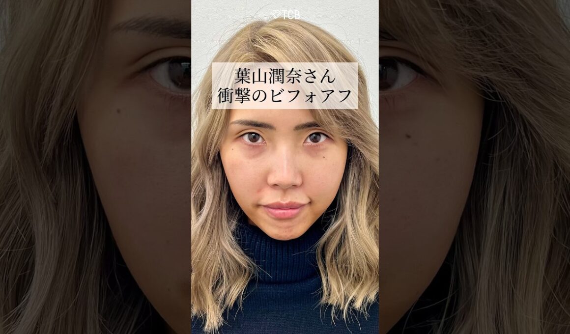 【クマ取り】葉山潤奈さん。衝撃のビフォアフ#shorts