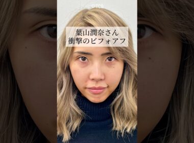 【クマ取り】葉山潤奈さん。衝撃のビフォアフ#shorts