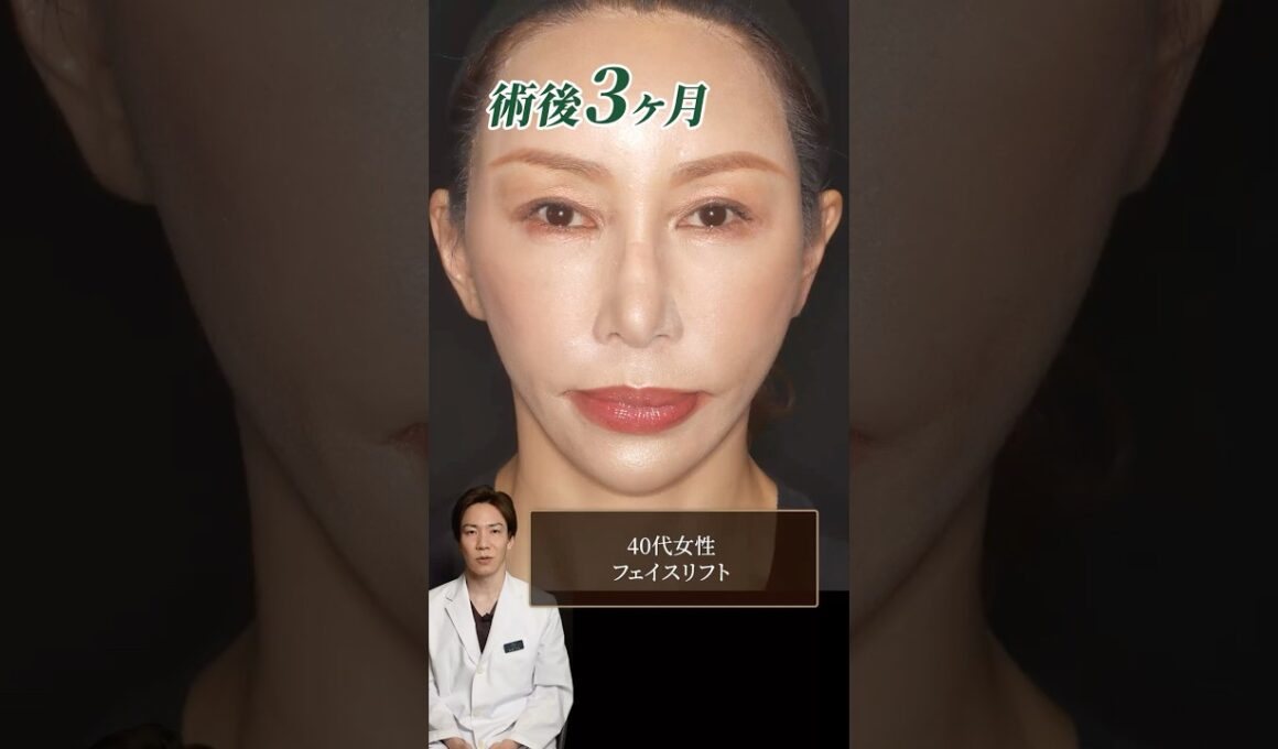 【症例解説】40代女性お顔のたるみをフェイスリフトで解決