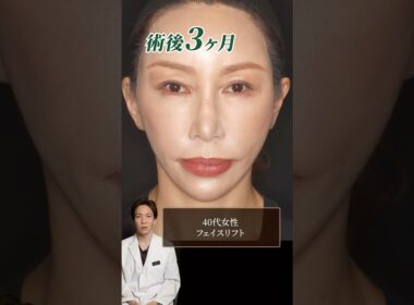 【症例解説】40代女性お顔のたるみをフェイスリフトで解決