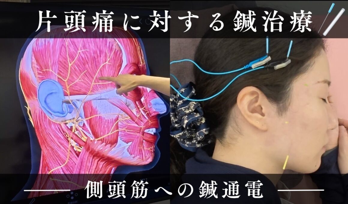 片頭痛に対する鍼治療 ‐側頭筋への鍼通電‐
