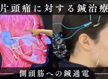 片頭痛に対する鍼治療 ‐側頭筋への鍼通電‐