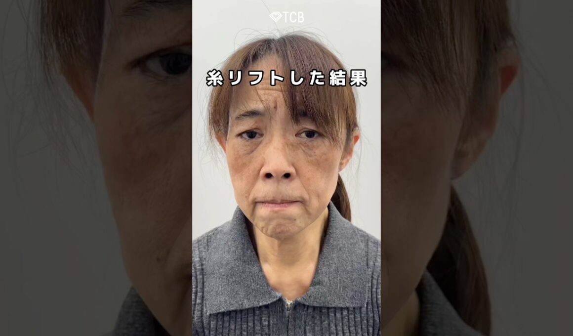 【糸リフト】衝撃の変化💥💥#shorts