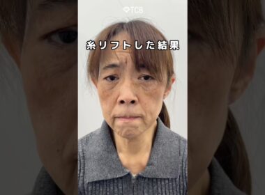 【糸リフト】衝撃の変化💥💥#shorts
