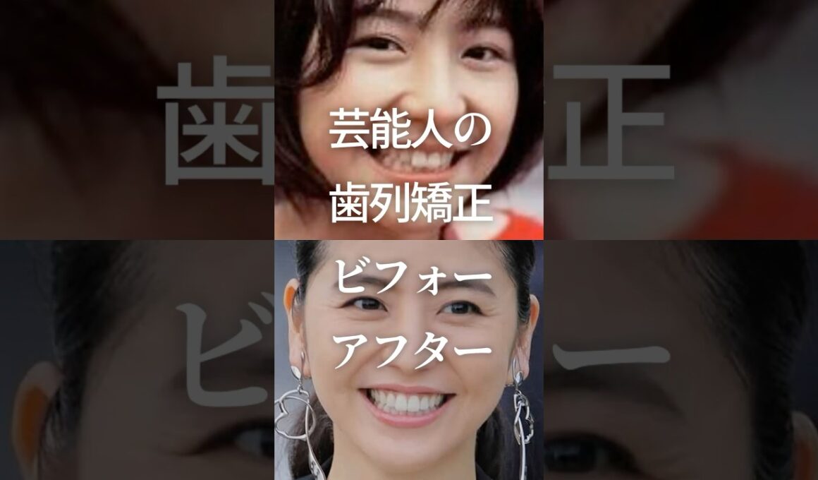 芸能人の歯列矯正ビフォーアフターPart3　#ガルちゃん #芸能人 #歯列矯正